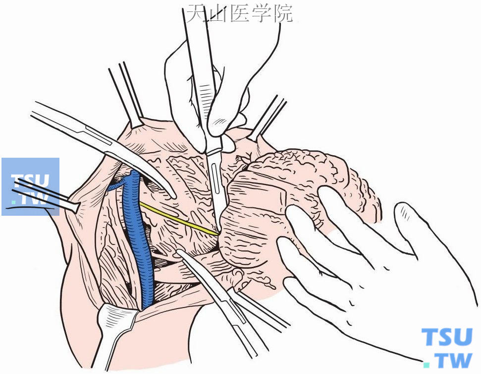 胸导管结扎术示意图图片