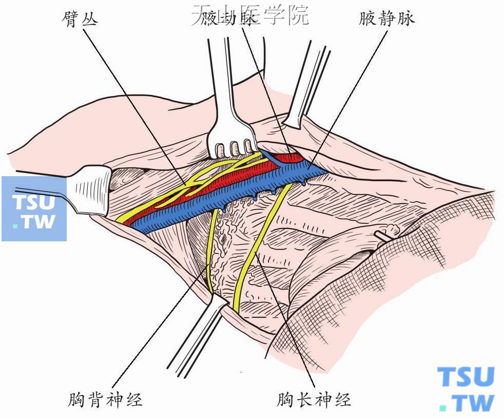 自上而下地将乳腺、胸大肌、胸小肌及腋窝内容一并切除