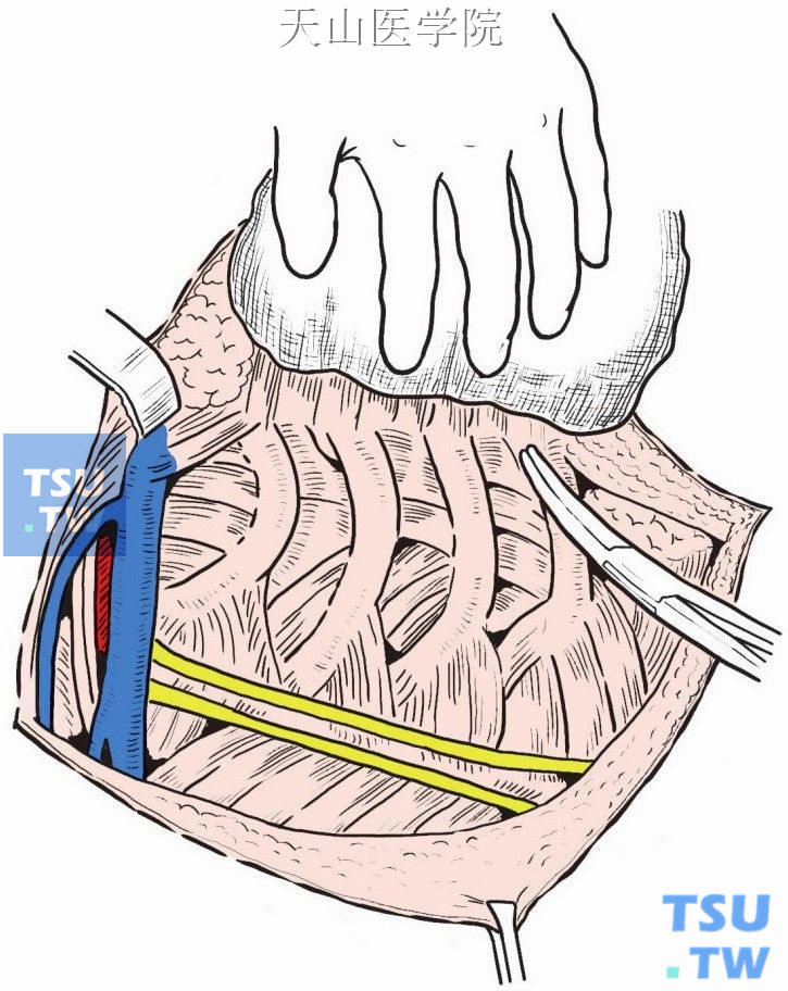 标本向内侧翻起，将胸小肌、胸大肌的胸壁附着点切断达肋骨、肋软骨交界部