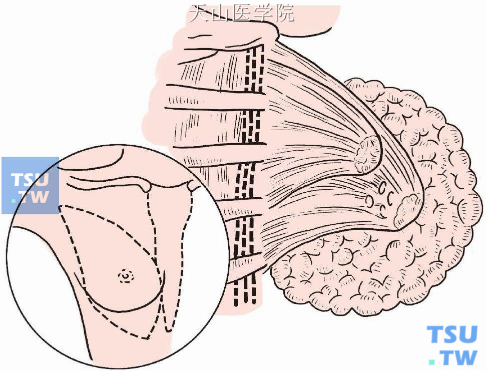 保留胸大肌与第2、3、4肋软骨及胸骨部的联系