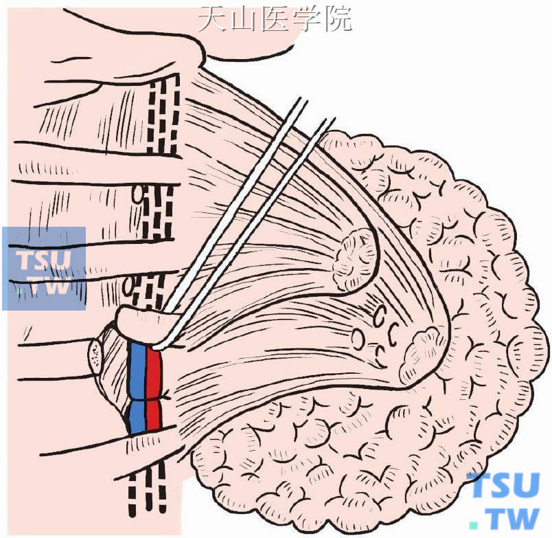 将第4肋软骨外侧切断，断端提起，即可找到内乳血管下端，予以分离结扎，再将肋软骨与胸骨连接部切断