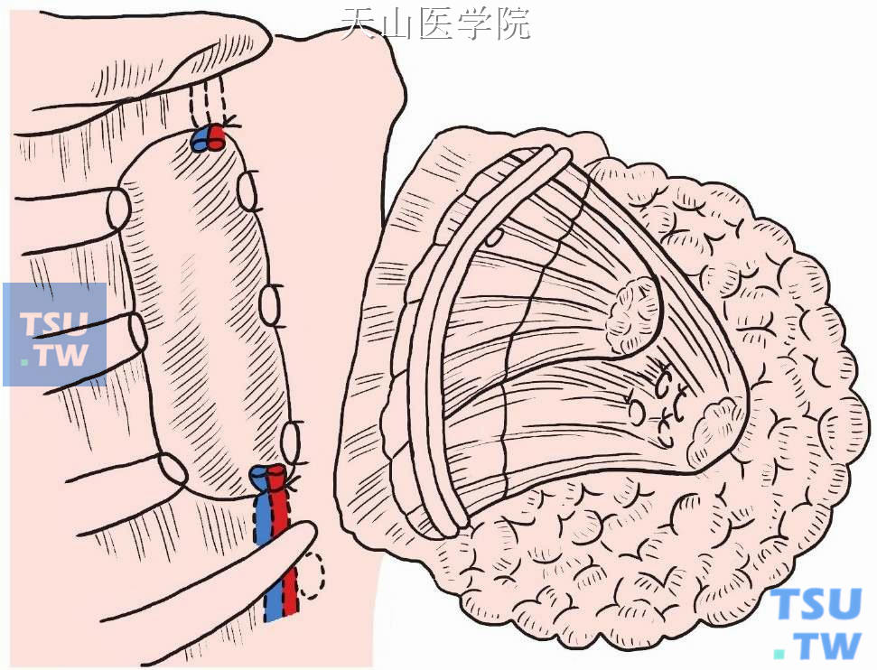 沿胸膜表面继续分离，将第2、3肋软骨与胸膜分开，第2肋间以上胸横肌消失，形成一层筋膜，此时用示指由下而上在肋软骨后方将胸膜推开，手指在第1肋间部顶出，然后依次切断第3、2肋软骨，切断胸大肌的胸骨附着点，标本即可整块切除