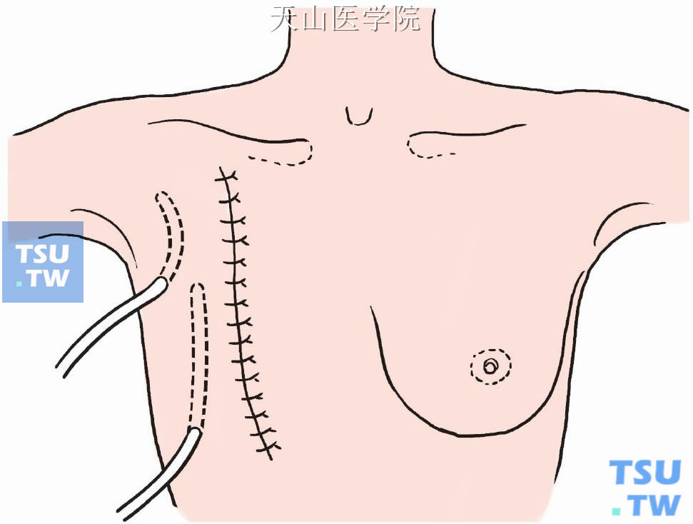 两侧皮瓣与胸壁固定数针依次缝合切口