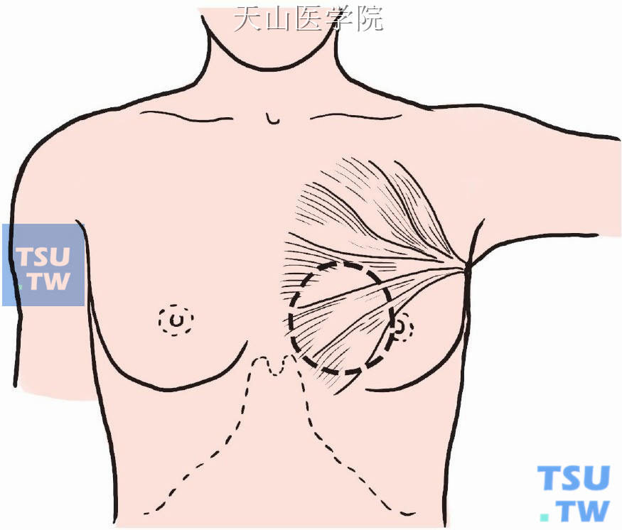 乳腺癌术后乳房再造术