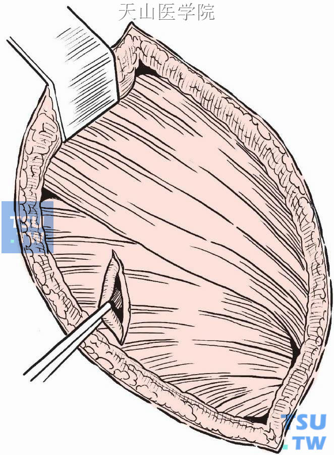 前锯肌切口做于第6或第7肋，长3～5cm。经切口插入手指做隧道，剪断前锯肌与肋骨间的纤维，进入胸肌下间隙