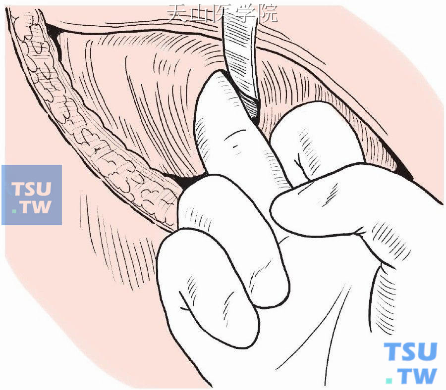 以手指扩展隧道，达到植入假体大小的范围，其上部于胸大肌与胸小肌之间