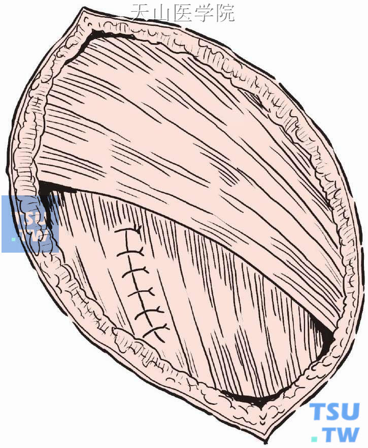 间断缝合前锯肌切口