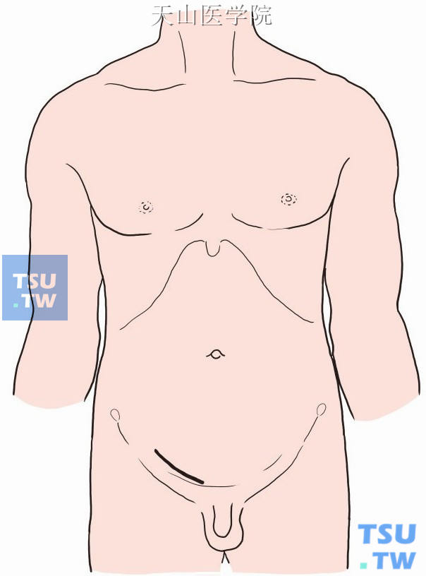 成人自腹股沟韧带中点上方2cm处向耻骨结节方向做一与腹股沟韧带平行之斜切口