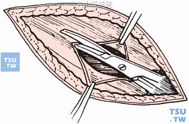 切开腹外斜肌腱膜，再沿纤维方向剪开