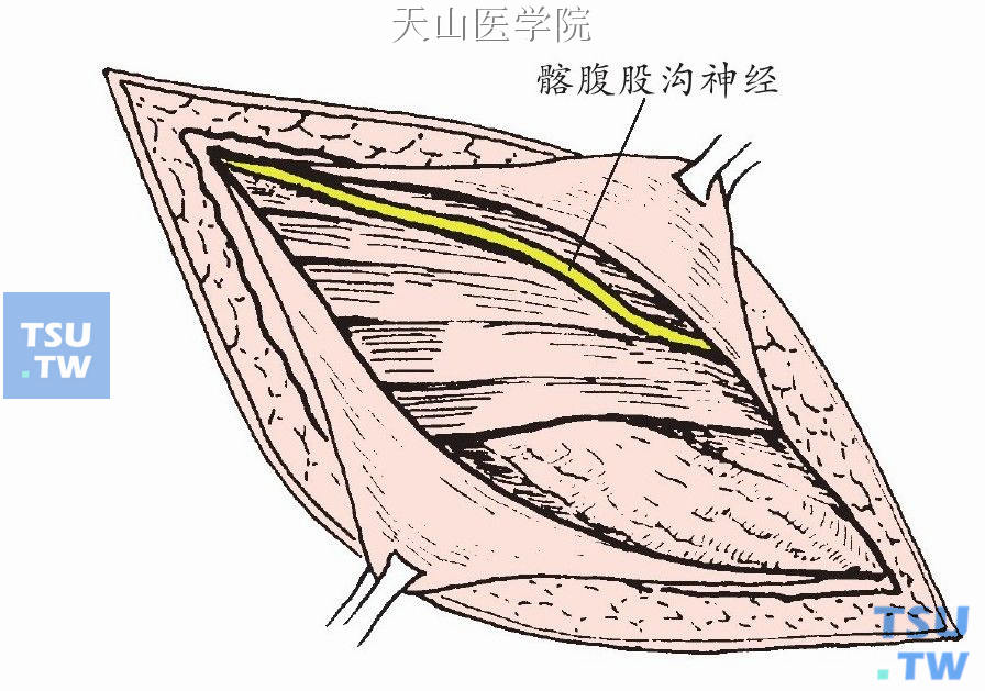 保护髂腹股沟神经