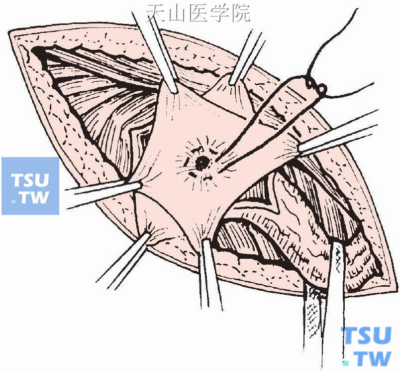 疝囊内荷包缝合