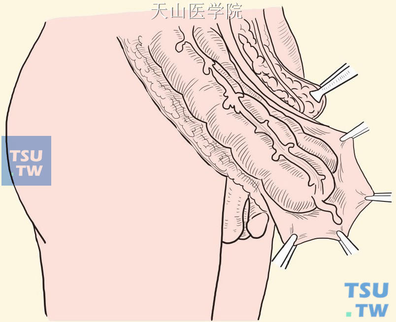 疝囊切开显露结肠