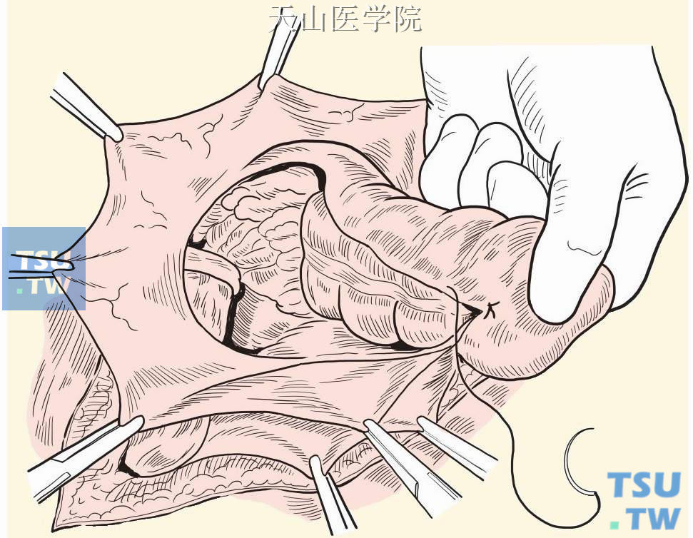 连续缝合结肠两侧囊壁，形成新的结肠后壁系膜
