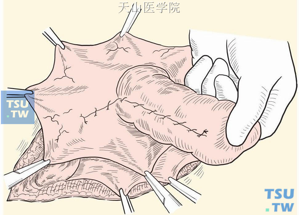 余下疝囊缺口连续缝合