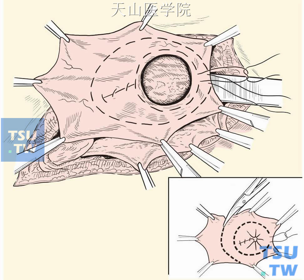 疝囊颈部荷包缝合结扎，切除多余囊壁
