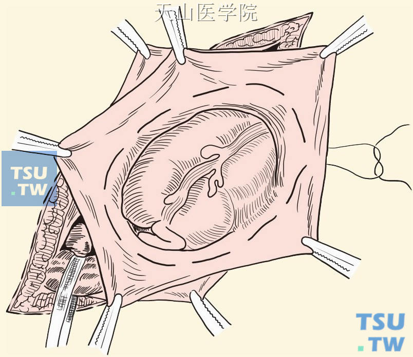 贴近肠壁的疝囊荷包缝合，剪去多余疝囊