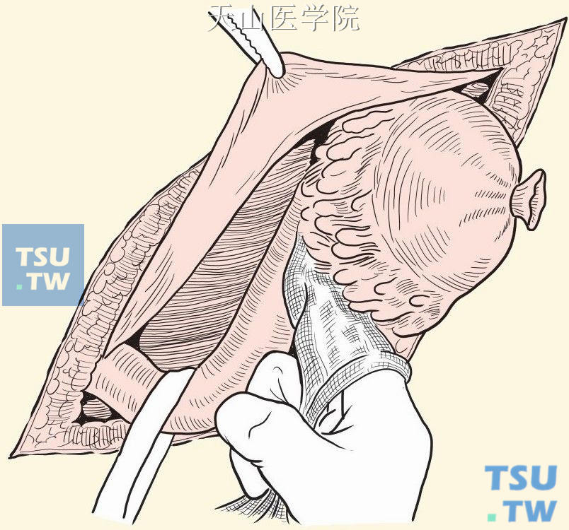 疝囊与精索组织钝性分开
