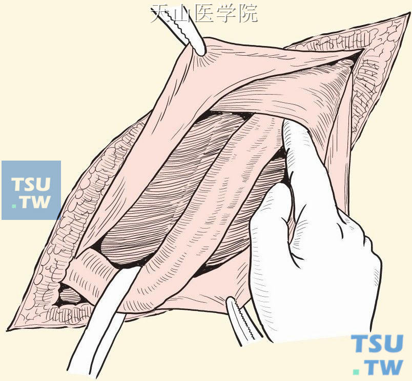 提起精索，将腹横筋膜缝于腹股沟韧带上以封闭内环