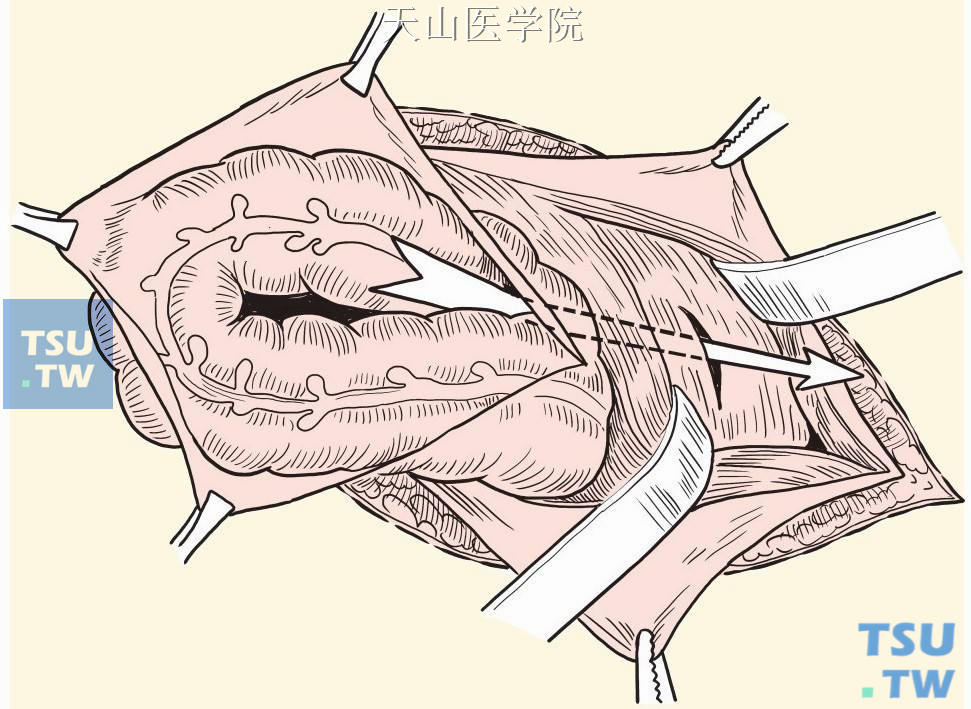 内环上方另做腹部切口，拉出乙状结肠