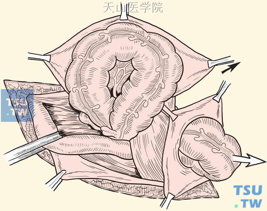 乙状结肠置于疝囊外侧面