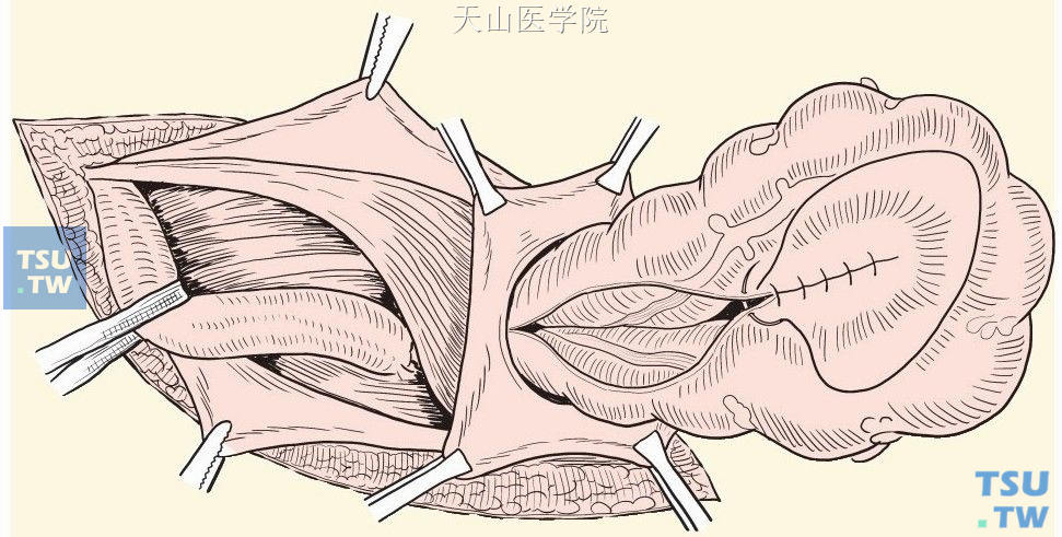 缝合裸露的外侧面，形成新的肠系膜