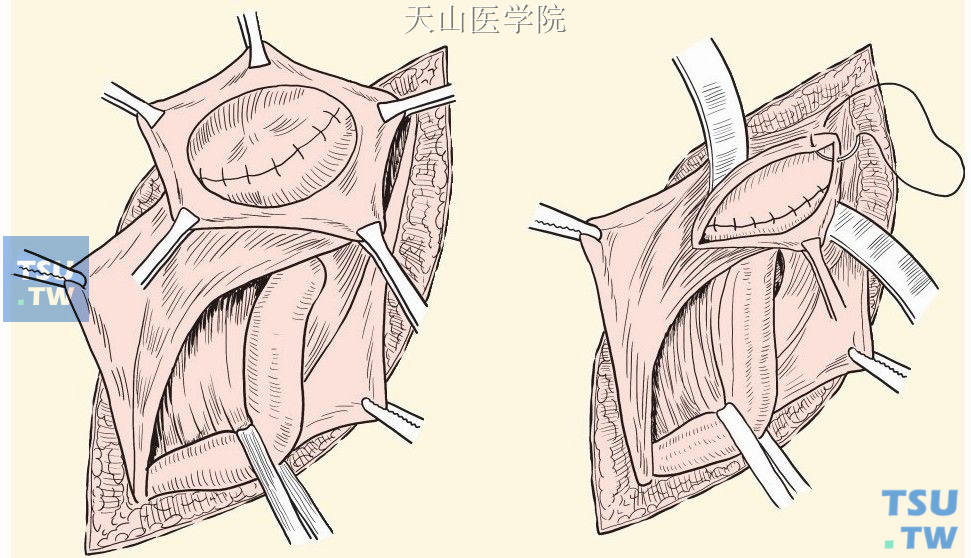 分层缝合内环上方切口处的腹膜与肌层