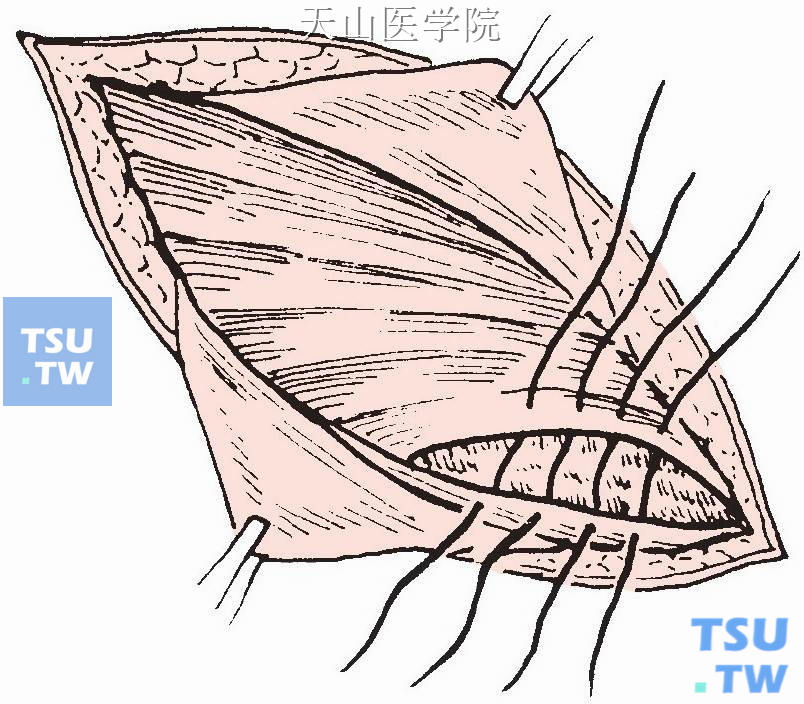 联合肌腱在精索前与腹股沟韧带缝合