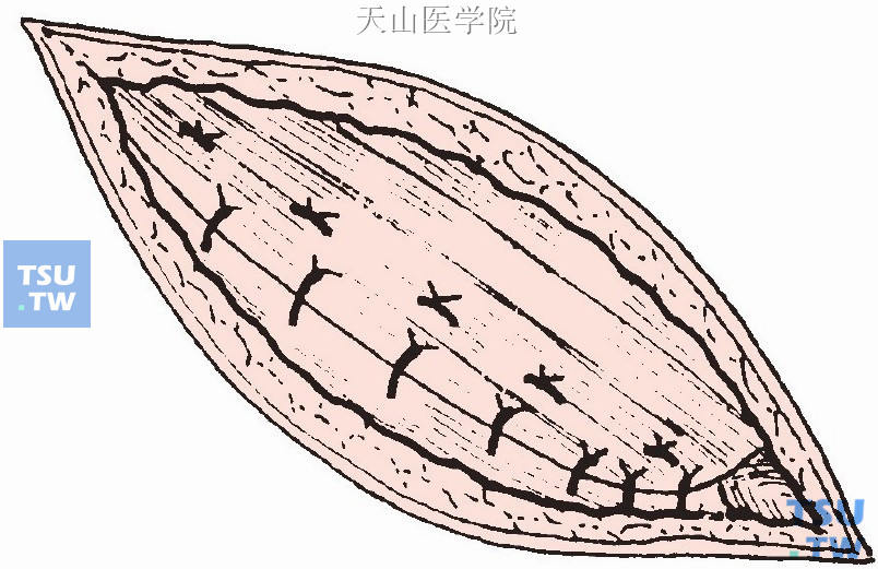 重叠缝合腹外斜肌腱膜