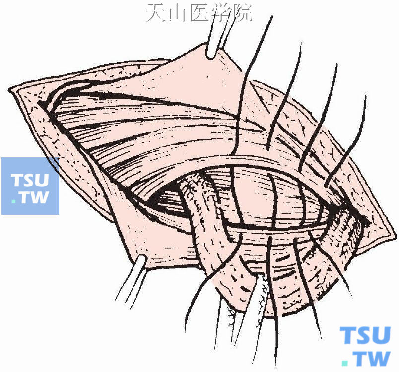 腹股沟斜疝修补术