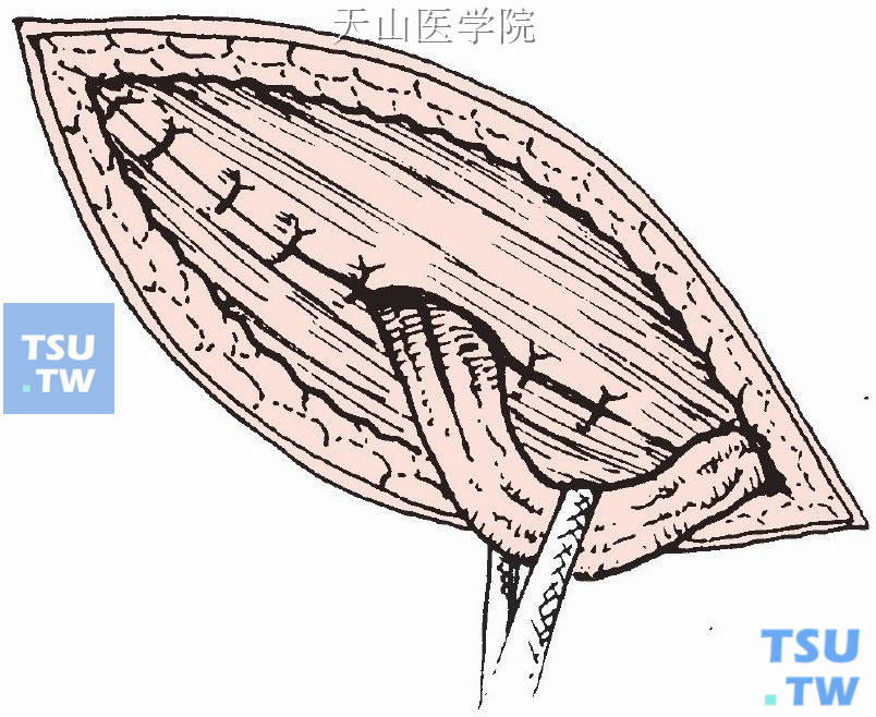 腹外斜肌腱膜在精索后缝合，精索位于皮下