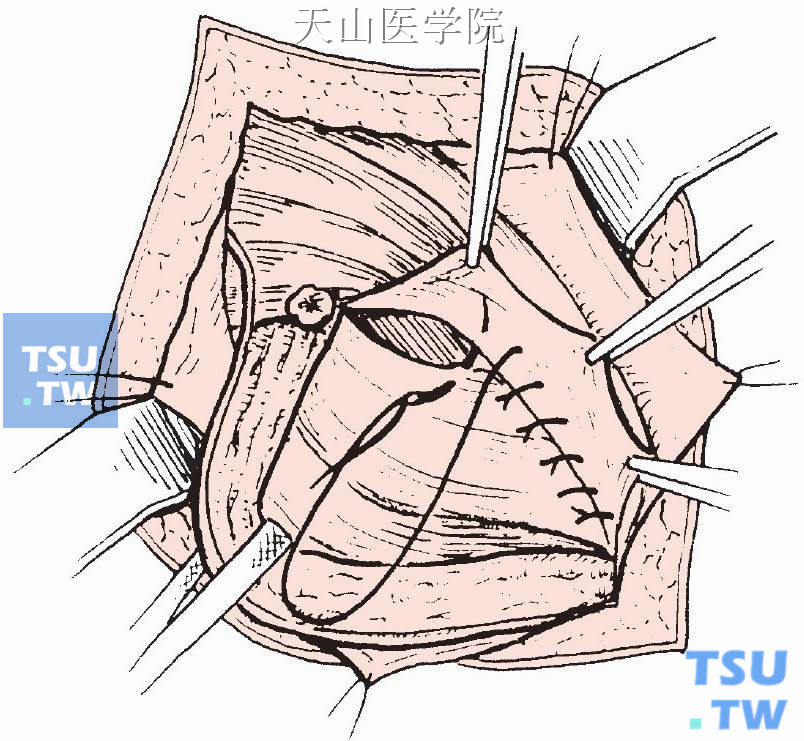 腹横筋膜做折叠缝合