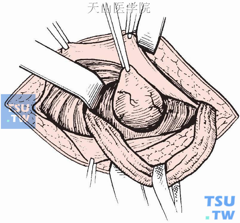 精索后内侧显露直疝疝囊
