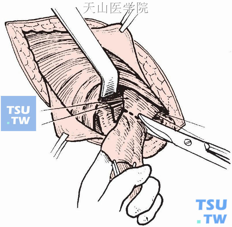 疝囊颈部缝牵引线，剪去多余疝囊