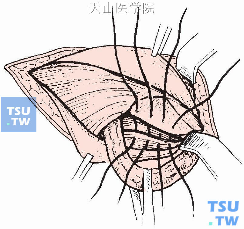 鞘膜翻转术图片