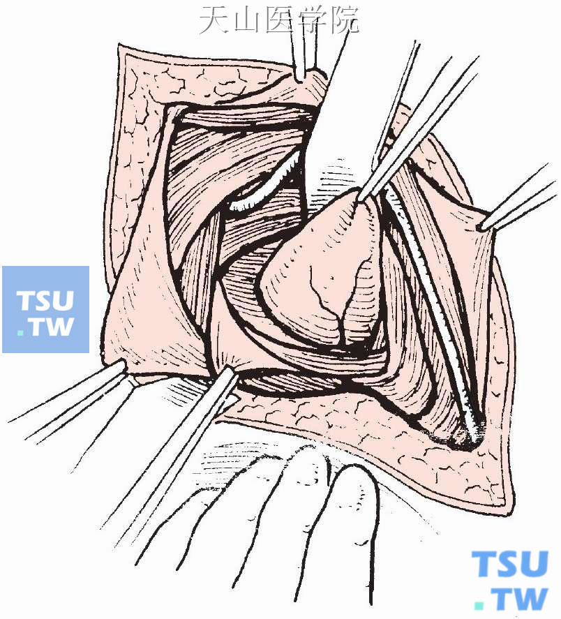 股疝修补术图片