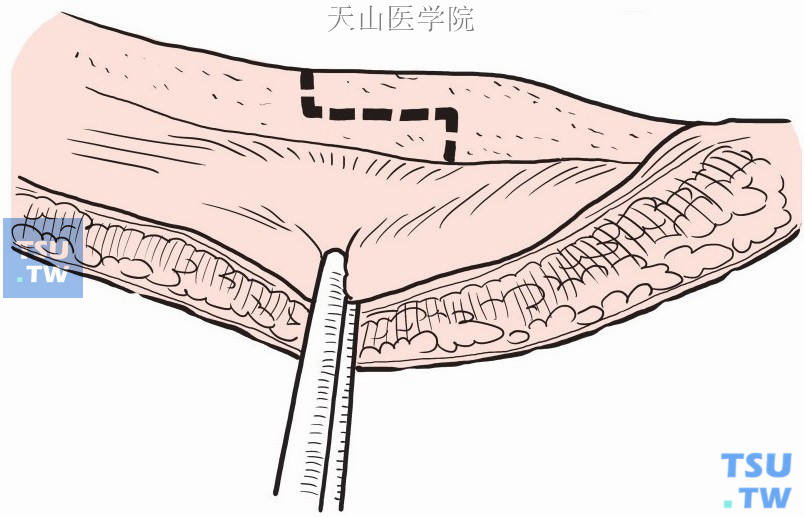 腹股沟韧带切开