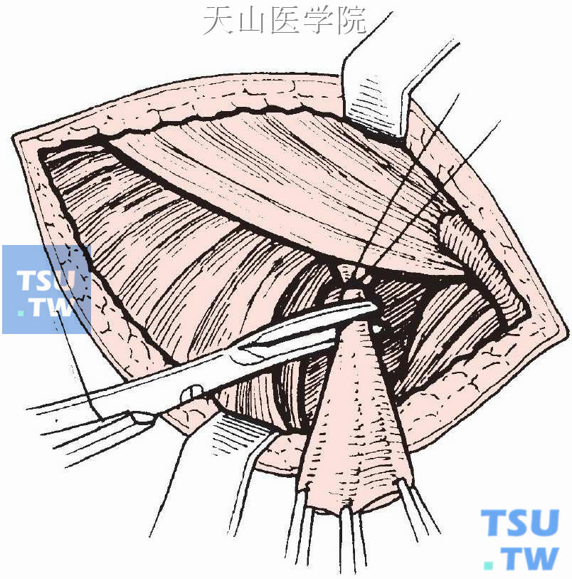 股疝修补术图片