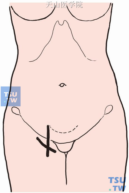 以卵圆窝为中心，在腹股沟韧带下3cm做斜切口，或在股动脉内侧，从腹股沟韧带上1cm向下做切口