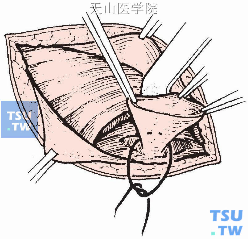 疝囊颈贯穿缝合