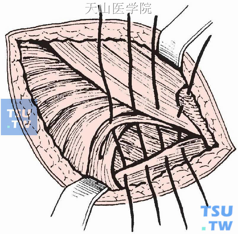 腹股沟韧带、阔筋膜镰状缘与耻骨肌筋膜缝合