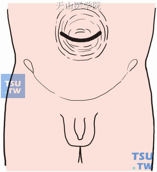 在脐孔下方做一弧形切口