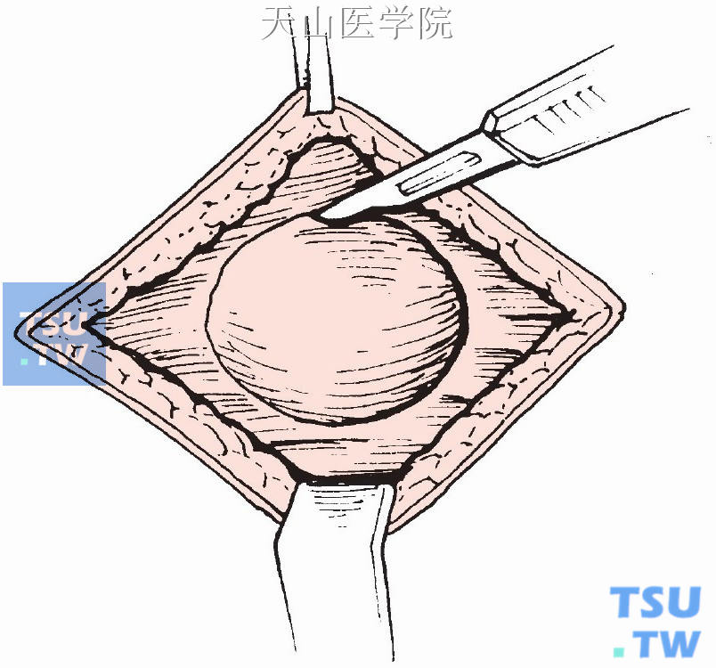 分离疝囊