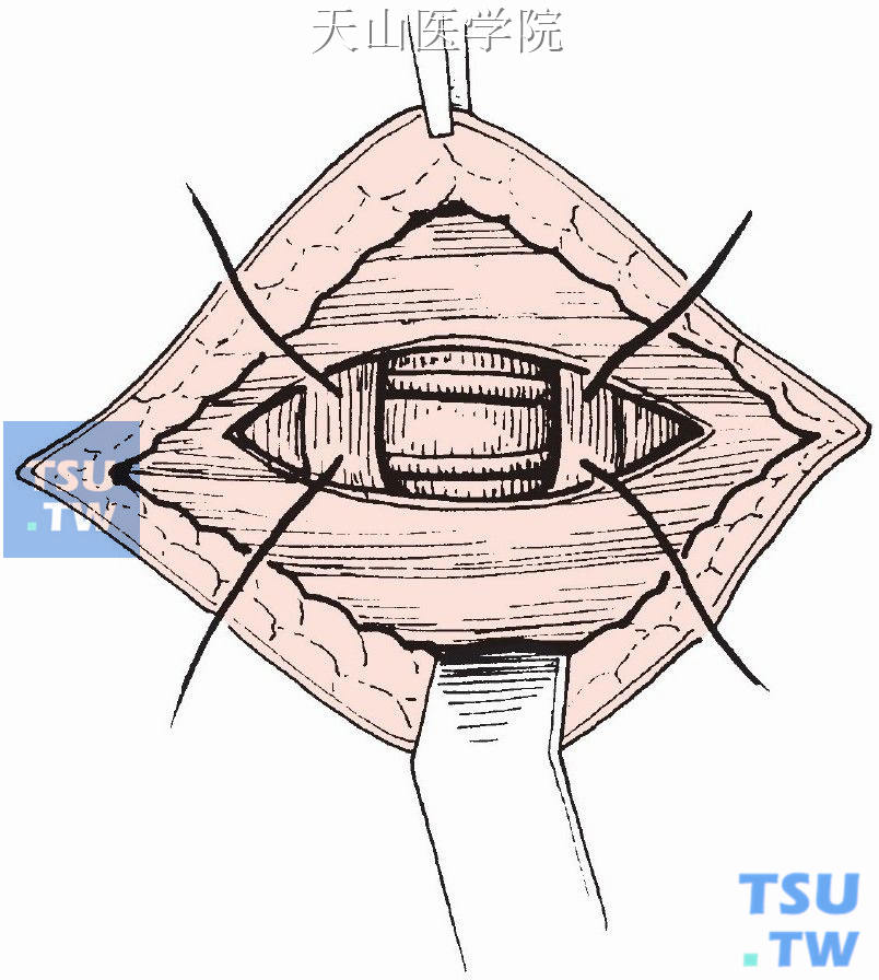 疝孔两侧腹直肌间断缝合