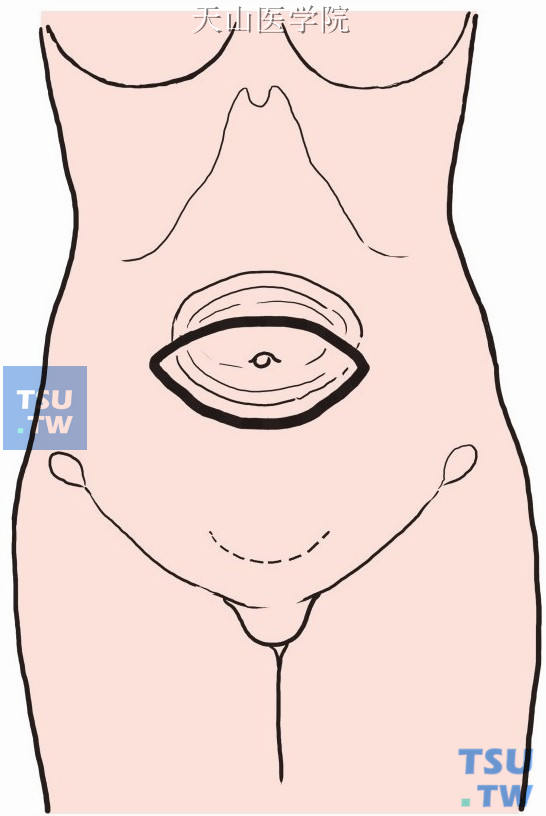 做脐部梭形切口，切除过多的皮肤及皮下脂肪组织