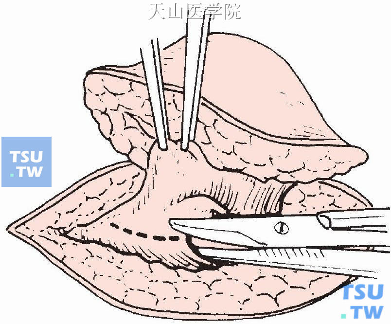 沿疝孔周围切开疝囊，注意勿损伤腹膜下的脏器