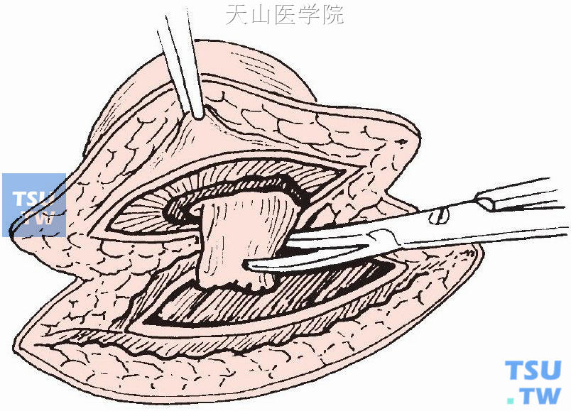 距疝环皮缘约2cm剪断疝囊