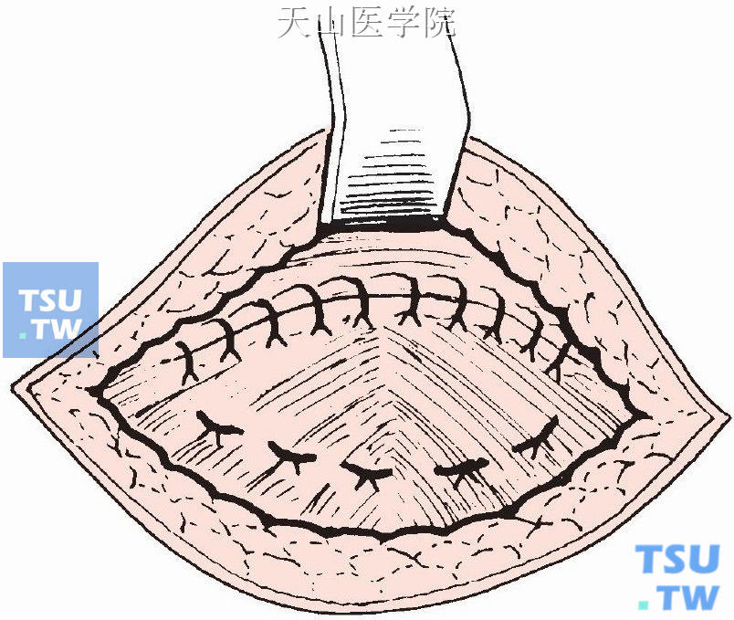 腹直肌前鞘上下两叶横向重叠缝合