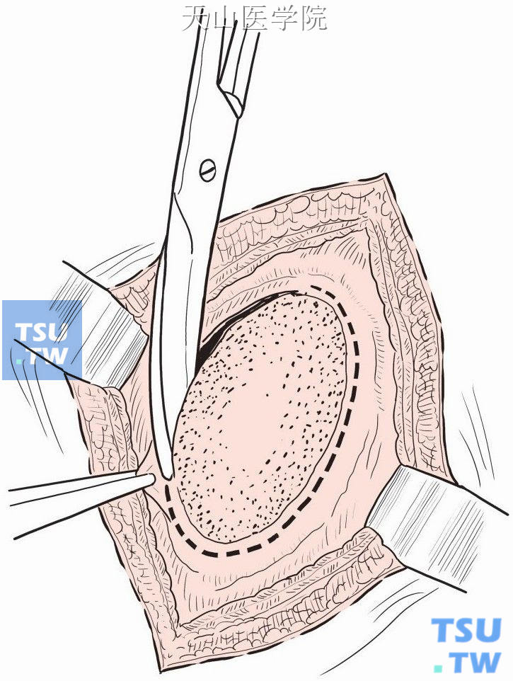 疝囊表面绕瘢痕做一椭圆切口