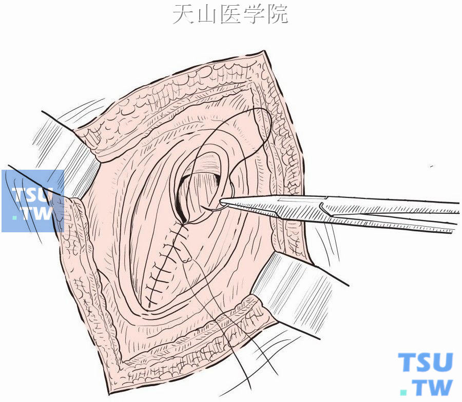 按解剖结构缝合腹壁各层次