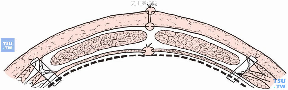 补片边缘缝线穿过腹壁打结固定